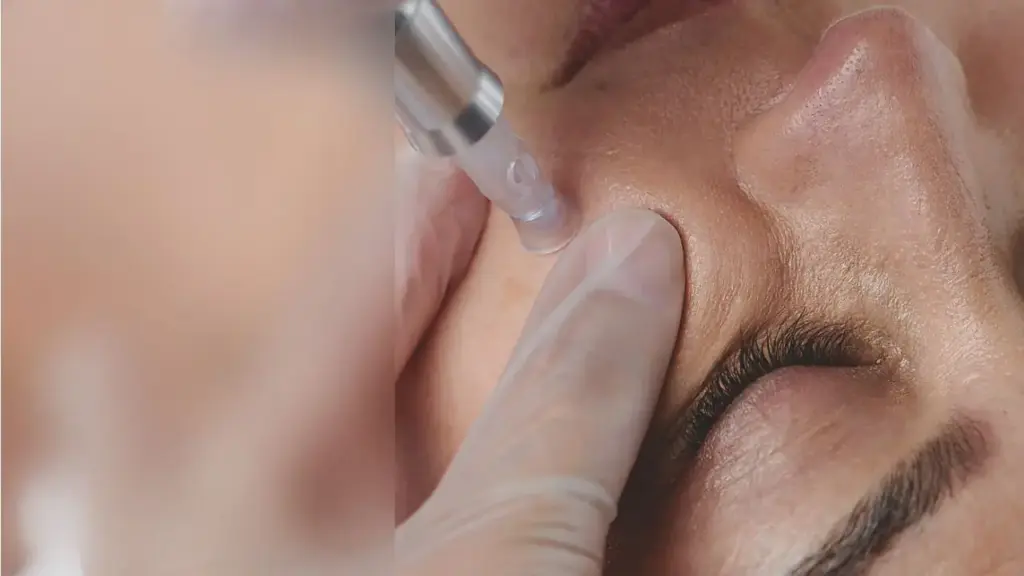 perbandingan kos rawatan microneedling dan rawatan muka lain